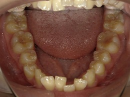 治療前下顎