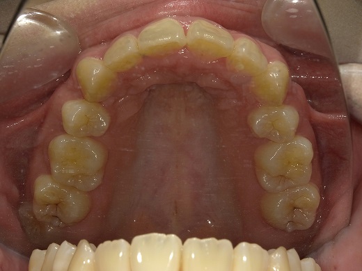 治療後上顎